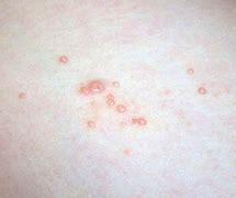 Image result for Molluscum Treatment Adults