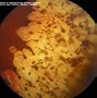 Image result for Choroid Plexus Papilloma