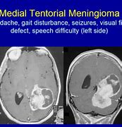 Image result for Left Temporal Meningioma