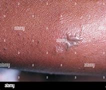 Image result for Gonorrhea Skin Lesions
