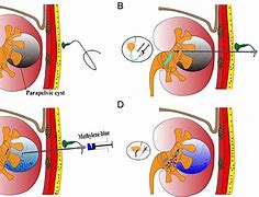 Image result for Parapelvic Renal Cysts