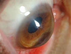 Image result for Keratoconus Eye