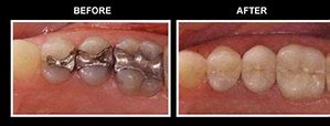 Image result for White Composite Filling vs Silver