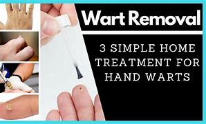 Image result for Hand Wart Removal