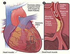 Image result for arterioscler�tico