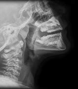 Image result for Steeple Sign Radiology