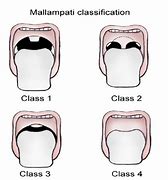 Image result for Mallampati Class