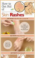 Image result for Allergic Skin Rash Treatment