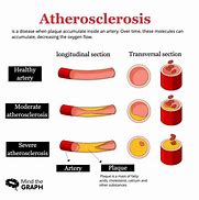 Image result for What Causes Atherosclerosis