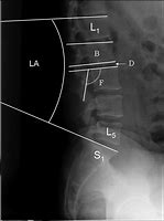 Image result for Ferguson. View Lumbar Spine