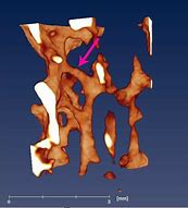 Image result for Jaw Bone Resorption