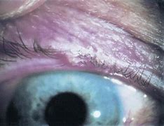 Image result for Molluscum Contagiosum Eyelid