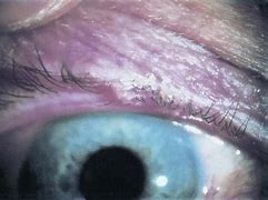 Image result for Molluscum Contagiosum Eyelid