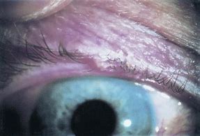 Image result for Molluscum Contagiosum Eyelid Margin