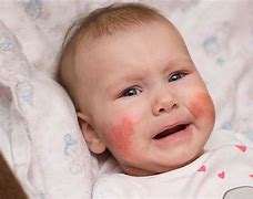 Image result for Baby Allergies
