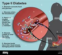 Image result for Type 2 Diabetes Mechanism