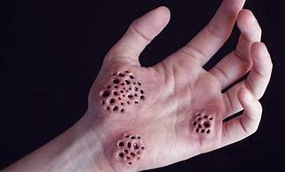 Image result for Cluster of Holes in Skin