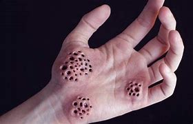 Image result for Trypophobia Disease