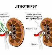 Image result for 7Mm Kidney Stone in Ureter Treat Men