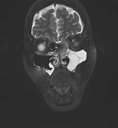 Image result for Inverted Papilloma Radiology/CT