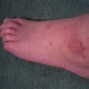 Image result for Ankle Rash Treatment