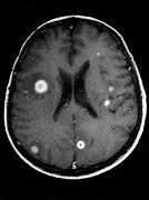 Image result for Age Spots On Brain