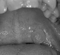 Image result for Squamous Cell Papilloma in Mouth