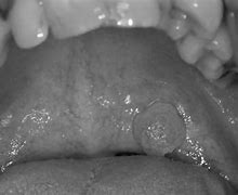 Image result for Papilloma Under Tongue