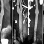 Image result for Carotid Web Ultrasound