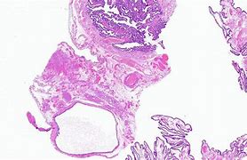 Image result for Cause of Paratubal Cyst