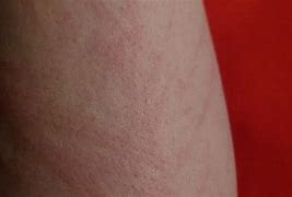 Image result for Skin Cancer Rashes