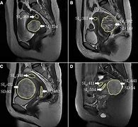 Image result for 4 Cm Fibroid Tumor