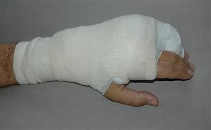 Image result for Broken Hand Cast