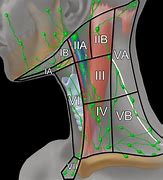 Image result for Lymph Node Dissection