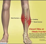 Image result for Stabbing Shin Pain
