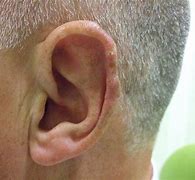 Image result for Basal Cell Skin Cancer Ear