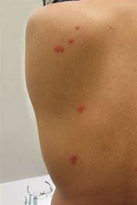 Image result for What Does Bed Bug Bites Look Like