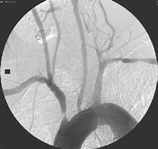 Image result for Leg Artery Stent