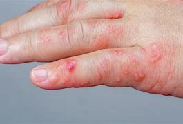 Image result for Blisters