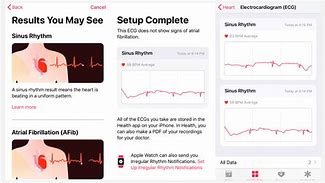 Image result for Af ECG Apple Watch