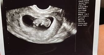 Image result for 9 Week Baby Ultrasound