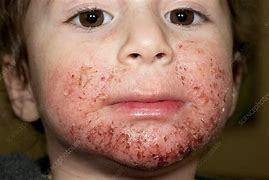 Image result for Atopic Dermatitis Eczema On Face