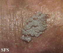 Image result for Sample Genital Warts