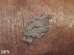 Image result for Genital Warts On Man