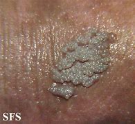 Image result for Genital Warts Cream