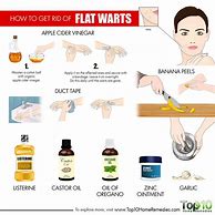 Image result for How to Get Rid of Warts On Hands Quickly