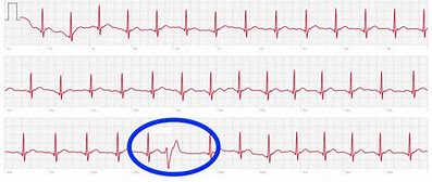 Image result for PVC On Apple Watch ECG