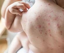 Image result for Chickenpox Kids