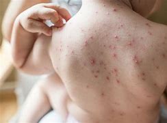 Image result for First Symptoms of Chickenpox