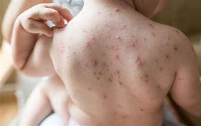 Image result for Chickenpox Child